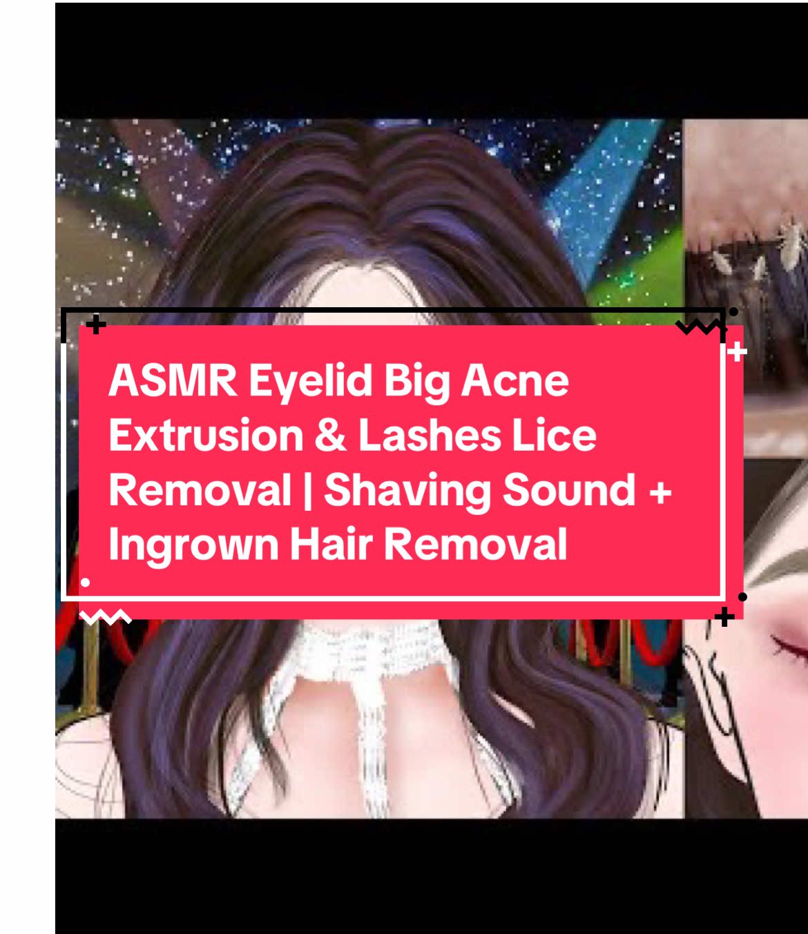 ASMR Eyelid Big Acne Extrusion & Lashes Lice Removal | Shaving Sound + Ingrown Hair Removal | ASMR Remove armpit big pustule and pimple popping | 겨드랑이 큰 농포와 뾰루지 제거 | Acne underarm animation ..!! 