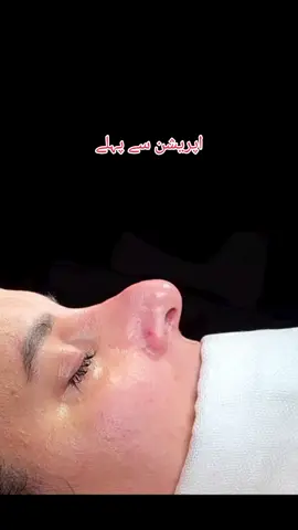 ناک کو بناے خوبصورت۔  #Rhinoplasty #Nosejob #Surgery #By #DrNajeebRhinoplasty #NoseReshaping #Surgery #CrookedNose #DeviatedNose #BestResults #BeforeAndAfter #Surgery #NoseSurgery #NoseJobSurgery #NoseSurgeryPakistan #NoseSurgery #NoseSurgery #RhinoplastyPakistan #Peshawar #Foryou #Fyp #ForyouPage #BoostYourConfidence #NoseTransformation #TurkishLookNose #Viral #ViralVideo #ViralVideoOnTikTok #DrNajeebDawar #@TikTok @TikTok LIVE @TikTok Creative Experts @TikTok Trends @TikTok for Business 