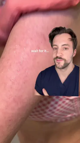 Easy hack for keratosis pilaris that works better than all of the products that are actually meant to treat it! #kp #keratosispilaris #armbasting #dermarkologist 