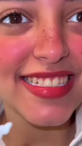 #الفينير_المتحرك 