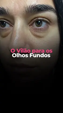 Esse procedimento é um vilão para os #olhos fundos! 👀❌ Estou falando do preenchimento de ácido #hialurônico para #olheiras. Na minha prática em consultório, vejo muitas pessoas apresentando inchaços e #bolsas devido a esses preenchedores. ⏳⚠️ Para evitar esses problemas, podemos usar estimuladores de #colágeno (mas não todos) e tecnologias que suavizam as linhas nessa área, além do #peeling de cróton. 🧬✨ Quer descobrir qual é o tratamento ideal para a área dos seus olhos? Para mais informações o nosso WhatsApp é o (11) 98508-1187. A Clínica está localizada na R. Bento de Andrade, 431 - Jardim Paulista, São Paulo. 