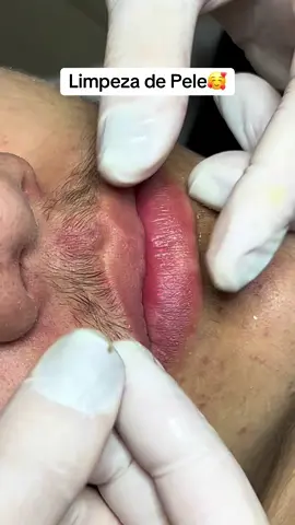 Limpeza de Pele ❤️ #viral #estetica #viraltiktok #beleza #limpezadepele #rejuvenescimento #skincare #skins #milium #cravoseespinhas #filamentossebaceos #comedaoaberto #comedaofechado #cravosgigantes #extraçaodecravos #extractions #cravosenormes #cravonaboca 