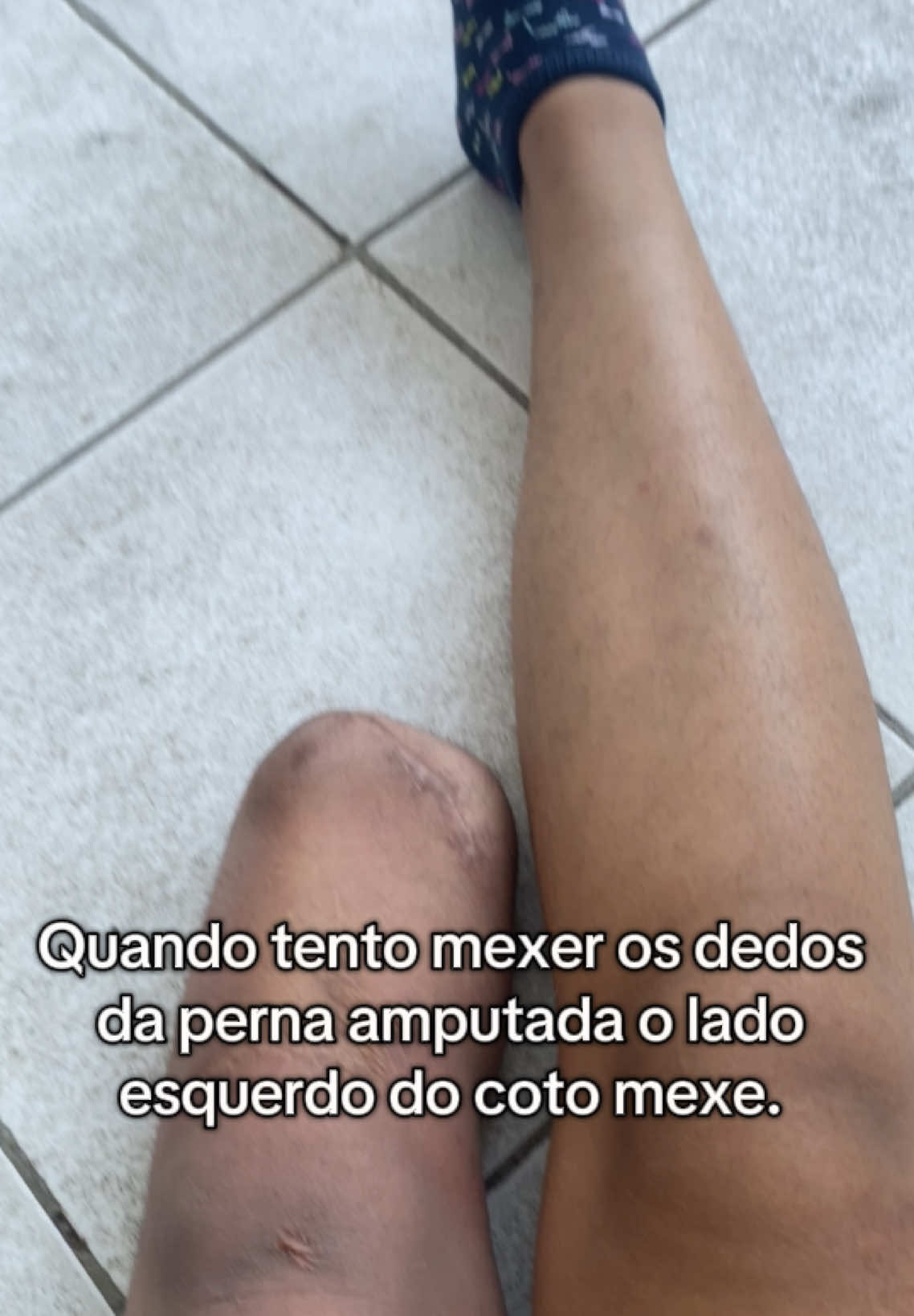 Amputado sofre 🥲🥲 #amputado #deficiente #fyyyp 