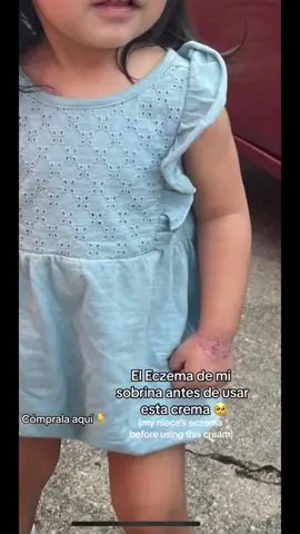 Les recomiendo esta crema le sano por completo la mano a mi sobrina, estuvimos batallando mucho para que le sanara por completo ya que ni las medicadas por su pediatra le servian #eczema #cream #eczemacream #seamoss #theoceanhealedmyeczema #eczemaawareness #dryskin #pielseca #ECZEMA #eczemaflareup #eczemahealing #cremaparaeczema