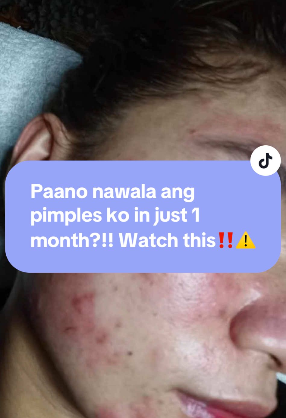 Kung nagihirapan kana sa acne mo watch this very #affordable #skincare #saludent #saludentfacialwhiteningset #facial #facialwhitening #trend #viral #trendingvideo #foryoupage #trendingtiktok #fyp #fypシ #fypシ゚viral #fypage 