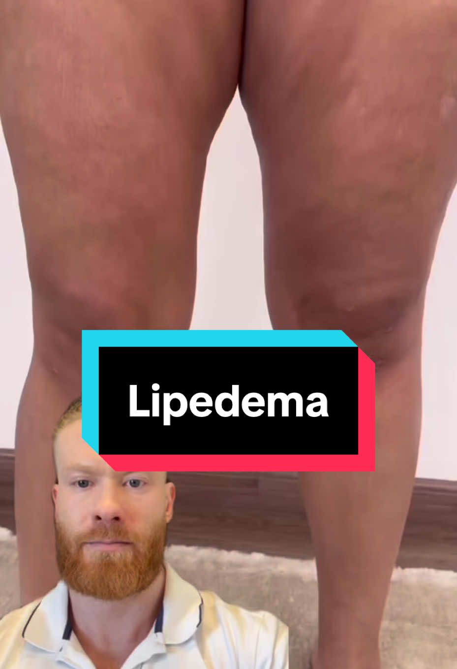 Lipedema: Como melhorar com fitoterápicos? O lipedema é o acúmulo de gordura nas pernas e braços, causando dor e inchaço. Fitoterápicos podem ajudar a reduzir a inflamação e melhorar a circulação. 🌿 Fitoterápicos que ajudam: 	•	Dimpless®: Reduz inflamação e inchaço com ação antioxidante. 	•	Mitburn: Acelera o metabolismo e ajuda na queima de gordura. 	•	Resveratrol: Melhora a circulação e reduz inflamação. 	•	Ubiquinona (CoQ10): Combate o cansaço e o estresse oxidativo. 	•	Metilcobalamina e Metilfolato: Melhoram o metabolismo energético e diminuem a fadiga. 👉 Dica: Associe a hábitos saudáveis para potencializar os resultados! Quer saber mais? Acompanhe o Seca Barriga!