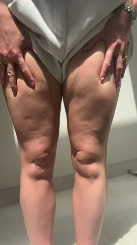 POV: You find a product thst completely removes your cellulite 🥹  #cellulite #looseskin #confidenceboost #instalift #confidentwomen #middleages #saggyskin #leglift #cellulitereduction