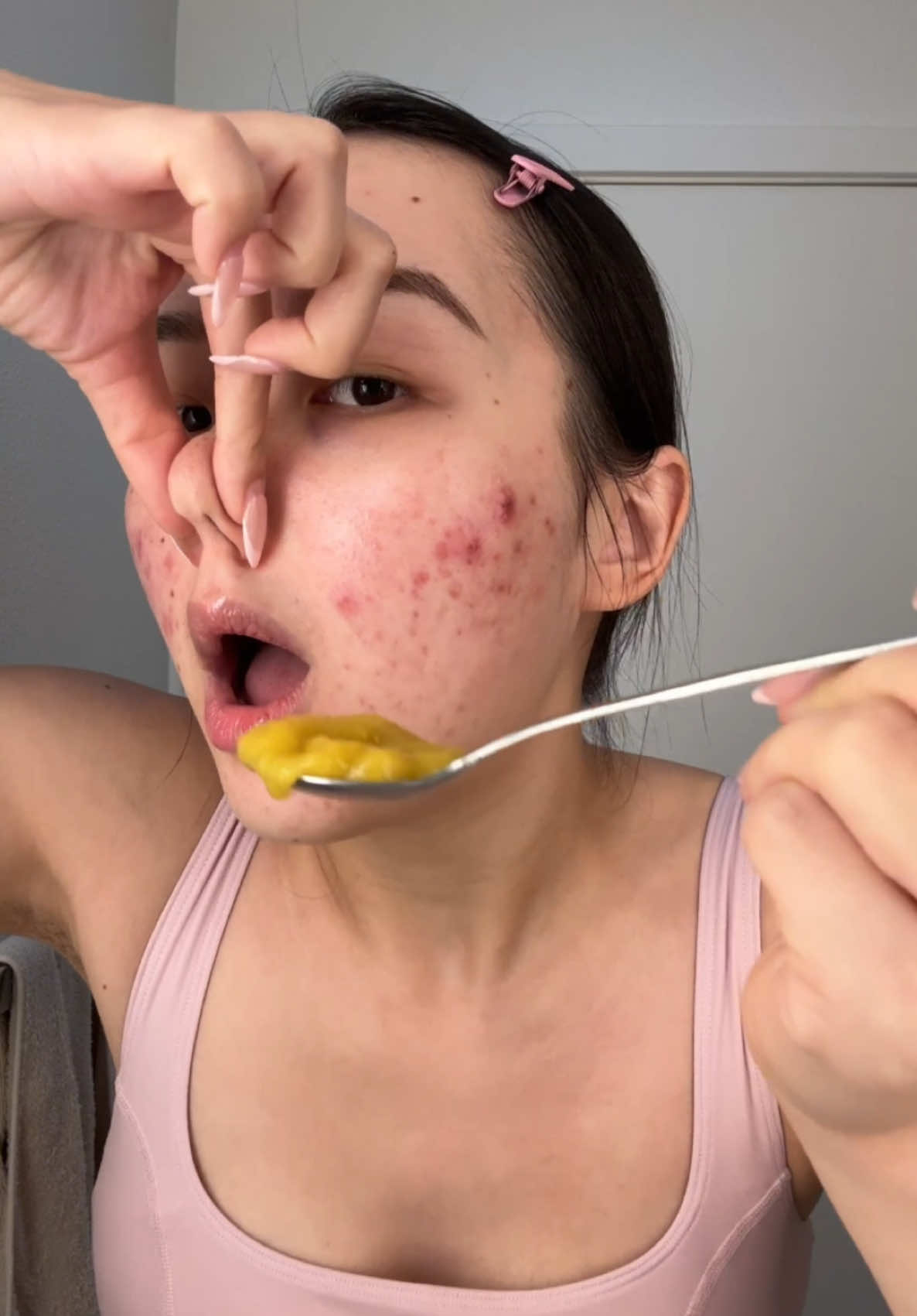 I COULDNT BREATHEE 😭 #acne #hormonalacne #acnetreatment #seamoss #acnetips #skincare #clearskin #acnejourney 