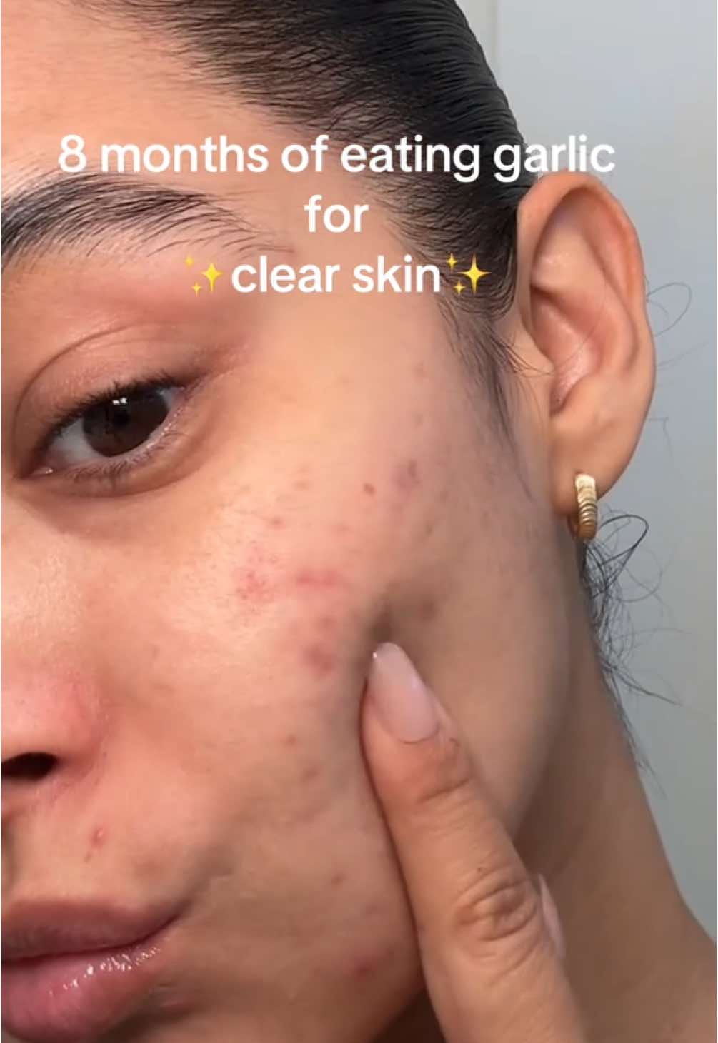 Results at the end🫶🏽 #garlicforacne #garlicandhoney #garlicforclearskin #skintransformation 