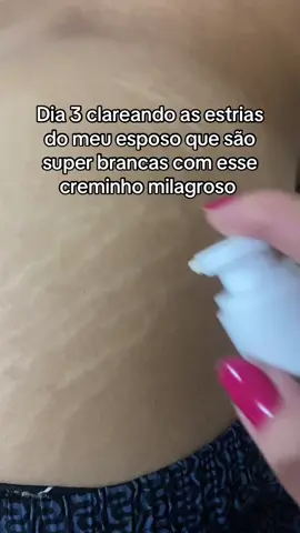 Parte 03: clareando as estrias do meu esposo #fyp
