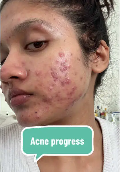 April and June was by far the toughest month😟  #acneproneskin #acneskin #acnejourney #acnefighter #acnefree #acnetransformation #acnebeforeandafter #acnetreatment #cysticacne 