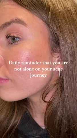 Daily reminder #acne #acnepositivity  #creatorsearchinsights 