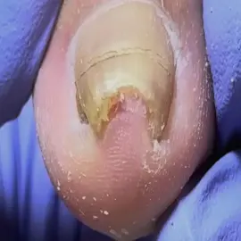 Trimming curled toenail #toenail #pedicure #修脚 #naildesigns #ingrowntoenail #ingrownnail #nailart #nails #nailtutorial #nail #fungusnailstreatment #nailsartvideos #fungusnails #fungus #toenails #móng #trending #trendingvideo