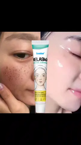 Sumifun MELASMA RELIEF CREAM #melasma #relief #cream #pyfツ 