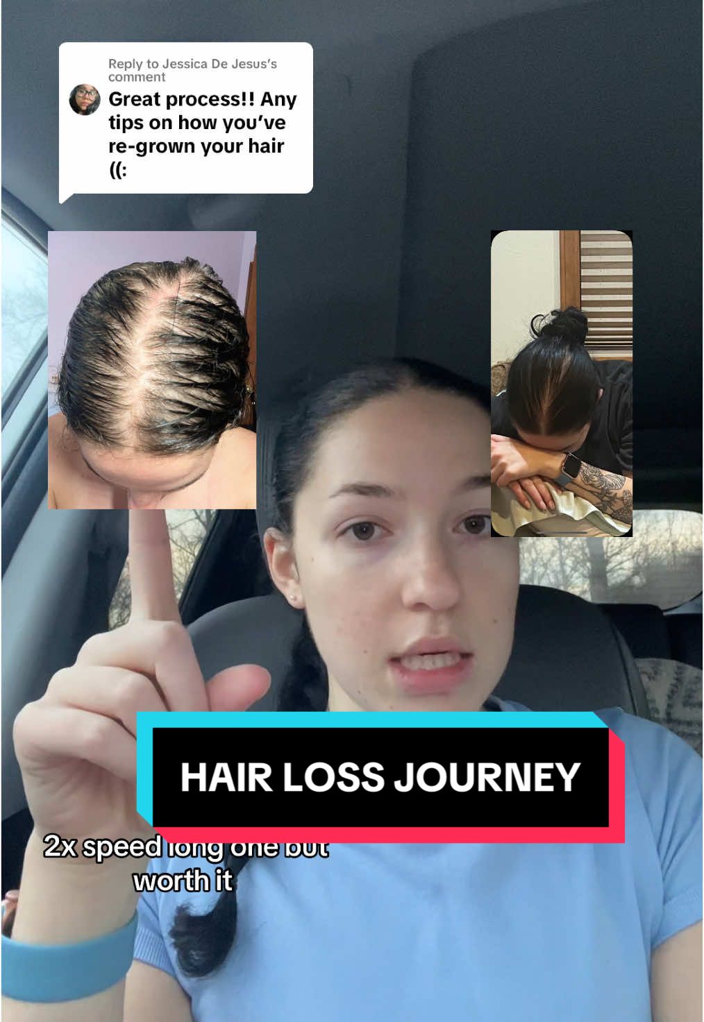 Replying to @Jessica De Jesus Help your girl out @THE OUAI this product changed my life, hair, and confidence. ILY<333 highly recommend this product any other questions ask me!! #balding #hairloss #hairgrowth #hairgrowthjourney #hairlosstips #hairgrowthtips #ouai #ouaiscalpserum #beforeandafter 