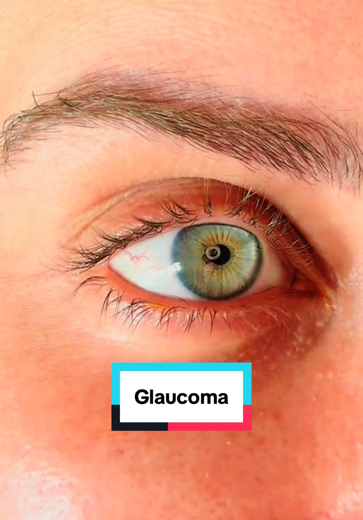 A paciente Bruna Barreto realizou uma cirurgia de Glaucoma e depois ficou com essa bolha no olho. Mas calma: Essa bolha faz parte do funcionamento da TREC, a trabeculectomia, que é a principal e mais realizada cirurgia para o glaucoma. 👀 Não precisa se preocupar: o corpo absorve a bolha em poucos dias. Quem aí também ficou assim? #oftalmologia #oftalmologista #bolhadear #glaucoma #visao #olhos #catarata #eye 