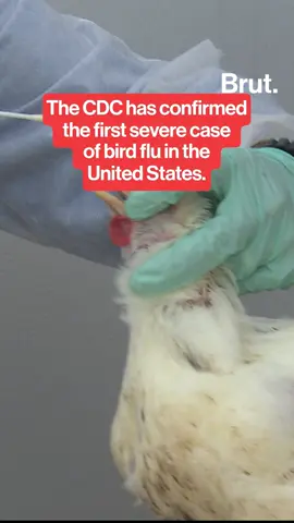The CDC has confirmed the first severe case of bird flu in the United States. This is the first reported U.S. case from a backyard flock. There is no evidence that the birds had contact with dairy cows or their products. #BirdFlu #CDC #Disease #Health #Medicine