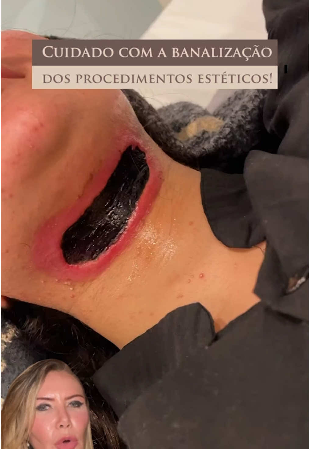 Você já ouviu falar em criolipólise? ⚜️ A criolipólise é um procedimento que visa a redução de gordura localizada. Funciona por meio de um equipamento que congela as células de gordura (adipócitos) em temperaturas controladas, levando-as à destruição gradual através de um processo chamado apoptose. Essas células são eliminadas naturalmente pelo organismo ao longo de semanas. ⚜️ Embora o método seja considerado seguro quando bem realizado, não é isento de riscos. Quando feito de forma inadequada — seja por falta de capacitação do profissional ou uso de aparelhos não regulamentados — podem ocorrer complicações graves, como queimaduras e até necrose.  ⚜️ Por isso, é importante que o procedimento seja realizado por profissionais qualificados e certificados, que utilizem equipamentos aprovados e sigam protocolos de segurança rigorosos. A avaliação prévia é indispensável para identificar se você é um bom candidato ao tratamento e evitar complicações. Já conhecia os riscos da criolipólise? Créditos: dr.rubenspontello #criolipolise #cuidadoscomapele #procedimentosesteticos #dermatologia #tratamentocorporal #reduçãodegordura #gorduralocalizada #beleza #informação 