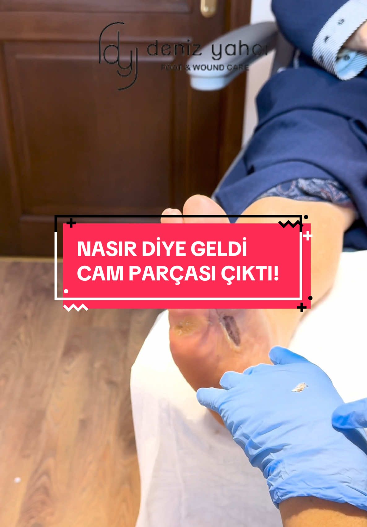 Diyabet hastalarında nöropatik his kaybı, ayak sağlığı açısından ciddi riskler taşımaktadır. Hastamızın ayağında fark edilmeyen bir cam parçası, yaklaşık bir aydır orada kalmış ve bölgede kanamalara ve doku hasarına neden olmuş. His kaybı nedeniyle bu durumu fark edemeyen hastamızın tedavisini tamamlayarak cam parçasını çıkardık ve nasır oluşumlarını temizledik. Bu durum, diyabetli bireylerde düzenli ayak bakımının ve günlük kontrolün ne kadar önemli olduğunu bir kez daha gösteriyor. Ayaklarınızdaki en küçük değişimleri bile ihmal etmeyin. Her gün mutlaka ayaklarınızı kontrol edin ve bir uzmandan düzenli bakım desteği alın. Sağlığınızı ertelemeyin! 👩🏻‍⚕️ Yara Bakım Hemşiresi & Podolog Deniz Yahcı 📍 Ortopodoloji Kliniği (Göztepe, Bağdat Caddesi No:229, Yenisey Apt. Kadıköy / İstanbul) 📞 Randevu ve bilgi için: 0 (216) 386 33 93 — 0 (533) 748 18 89 Sağlıklı adımlar için hemen randevunuzu alın! #ortopedi #ayakbakımı #diyabet #ortopedia #footcare#ortopodoloji #diyabetikayak #orthopedic #podoloji #nöropati