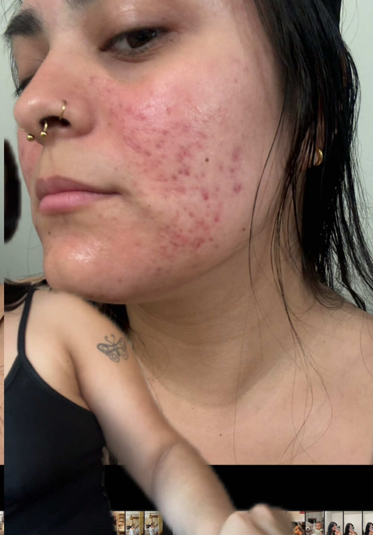 the before and after is crazy😭😭#koreanskincare #anua #hormonalacne #hormonalbreakout #greenscreen 