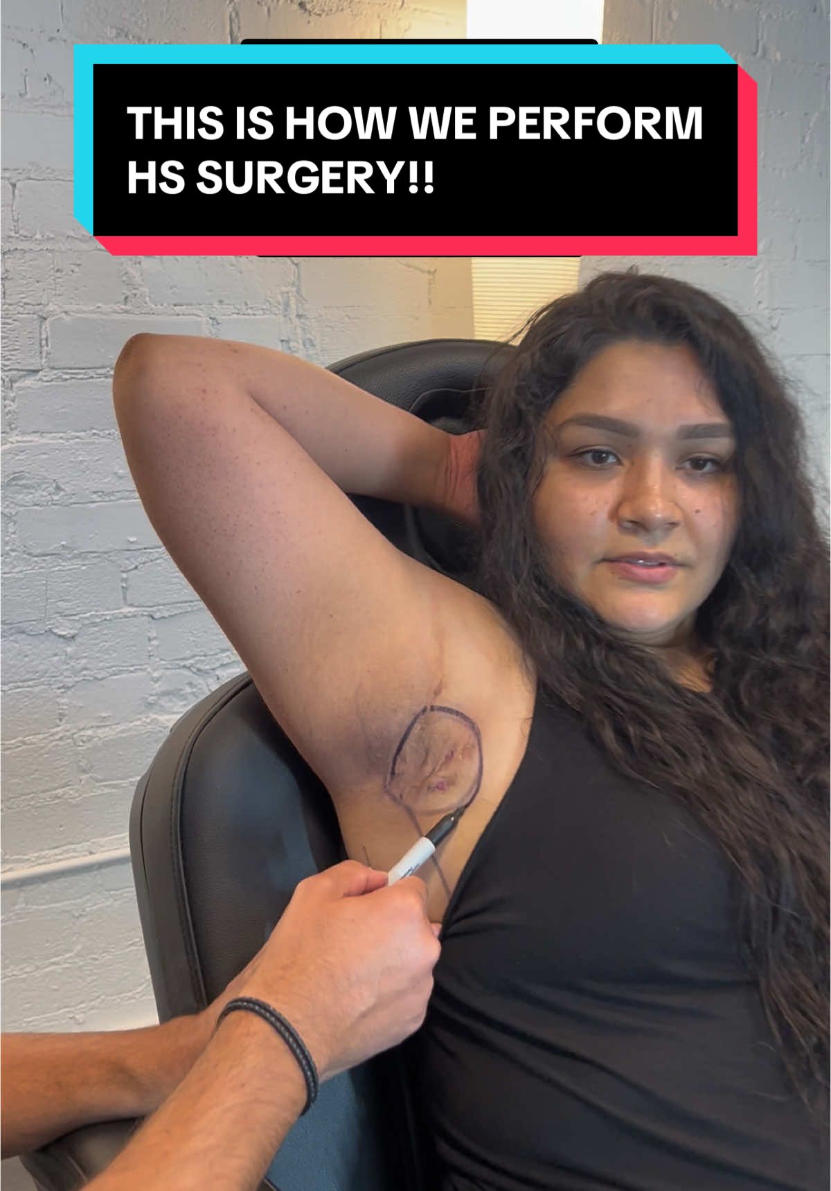 This is how we surgically treat Hidradenitis Suppurativa #tiktok #LearnOnTikTok #viralvideo #hidradenitissuppurativa #hidradenitissuppurativawarrior #hidradenitissuppurativaawareness #hs #skindisease #skin #patient #surgery #fyp #surgeonsoftiktok #plasticsurgery #reconstructivesurgery #doctorsoftiktok 
