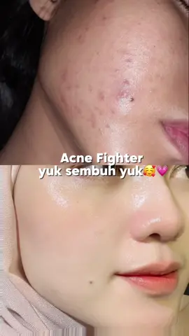 Semangat pejuang acne fighter 💪🏻 #drleo #drleoid #drleoclaymask #claymask #skincareindonesia #tiktokshoppayday 