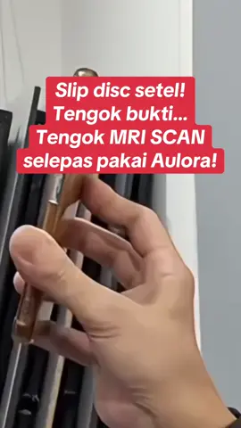 Amazing slip disc testimony. Slip disc setel selepas pakai Aulora Pants! Tengok before dan after MRI Scan! #aulorapantswithkodenshi #slipdisc #auloraseries #aulora #slipdisctreatment #physiotherapy #fisio #rawatanslipdisc #mri #bloodcirculation #pengalirandarah #backpain #lowerbackpain #sakitpinggang #beinternational #fypシ #fypシ゚viral #fyp #fypmalaysia 