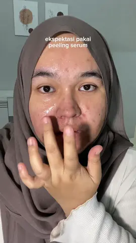 kerasa bgtt pori2 mengecil abiss pakai iniii 🥹 #YOUpeelbetter #YOUpeelingserum #peelingserum #exfoliatingserum #serumexfoliasi #skincare #exfoliation #fyp 