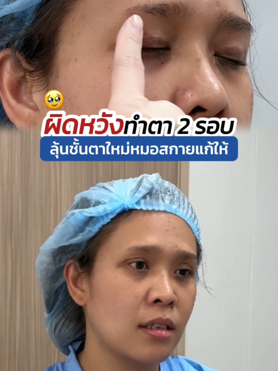 #เคสแก้ตา ผิดหวังมาแล้ว 2 รอบ ลุ้นชั้นตาใหม่กับ #หมอสกาย 😲 #สกายคลินิก #จักษุแพทย์ #skyclinic #ทําตาที่ไหนดี #รีวิวทำตาสองชั้น #sweeteyes #ศัลยกรรมตา #คลินิกทําสองชั้น #หนังตาตก #รีวิวบิวตี้ 