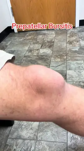Large Prepatellar Bursitis #sportsmedicine #sportsmed #residency #caqsm #familymedicine #medstudent #medicalstudents #premedstudent #premedlife #orthopedics #kneebursitis #prepatellarbursitis #kneeswelling #kneepain 