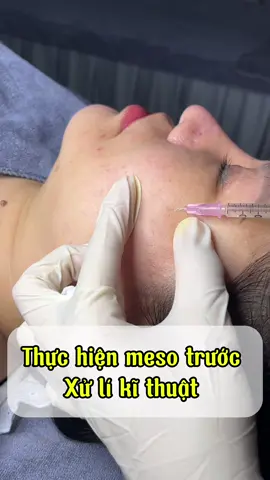 Meso thôi. Tuôn máo rồi xin tiktok đừng ẩn bài em 🙃🙃#Kbeautyspa #mesotherapy #xuhuong2024tiktok 