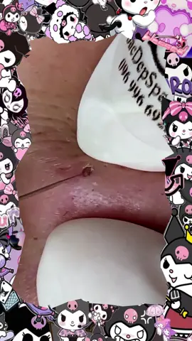 #relaxing #pimple #blackhead #fyp #satisfyingvideo #cravos #espinhas