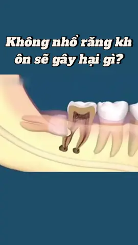 Nhổ răng khôn,đó là co’n ác mông của tôi😭🦷#nhakhoa #răng #dental #dentistry #Trámrăng #răngkhôn #răngkhôn #dentalcare #healthylife 