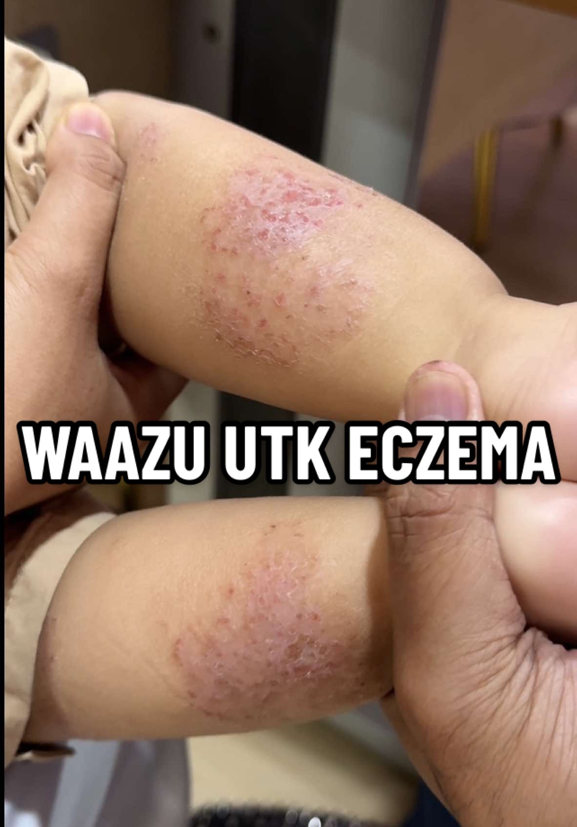 Waazu Untuk Kulit Baby Eczema 👍🏼