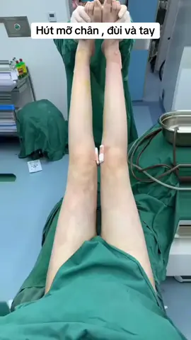 Muốn chân nhỏ , thon gọn giải quyết hoàn toàn bắp bị to pp hiệu quả nhất là hút mỡ .#xuhuong #viral #hutmotoanthan #hutmodui