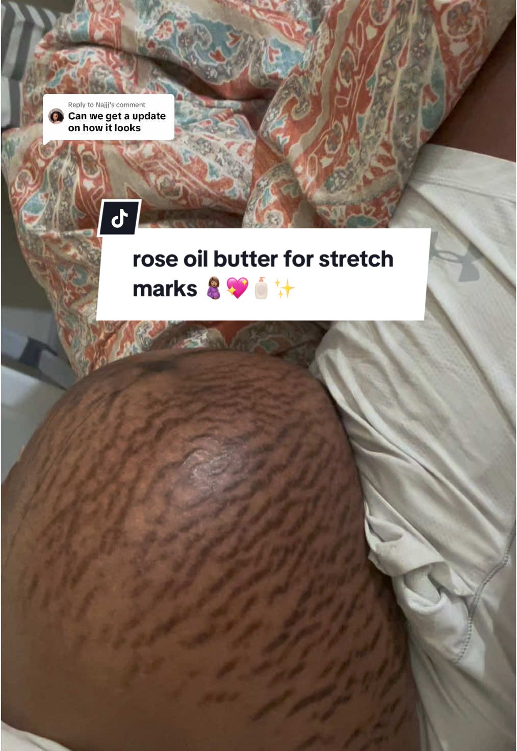 Replying to @Najjj I've been using Rose Oil Butter by Bodstry for just 25 days, and I've seen AMAZING results! 😍😍😍 Honestly, I thought I would have dark, loose skin forever… BUT Rose Oil Butter!!! You guys have to try their product and let me know how it works for you! 🥰🧴💖 @Bodystry #stretchmarks #postpartumbody #postpartumjourney #hyperpigmentation #skintransformation #skincare #skintreatment #mombody #mombodypositvity #weightlosstransformation #postpartumbelly 