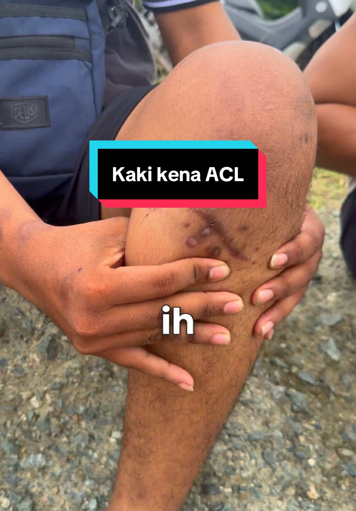 Pertama kali ngeliat kaki orng yang kena ACL ternyata bikin ngilu😭, lekas sembuh ya buat yang sedang pemulihan #acl 