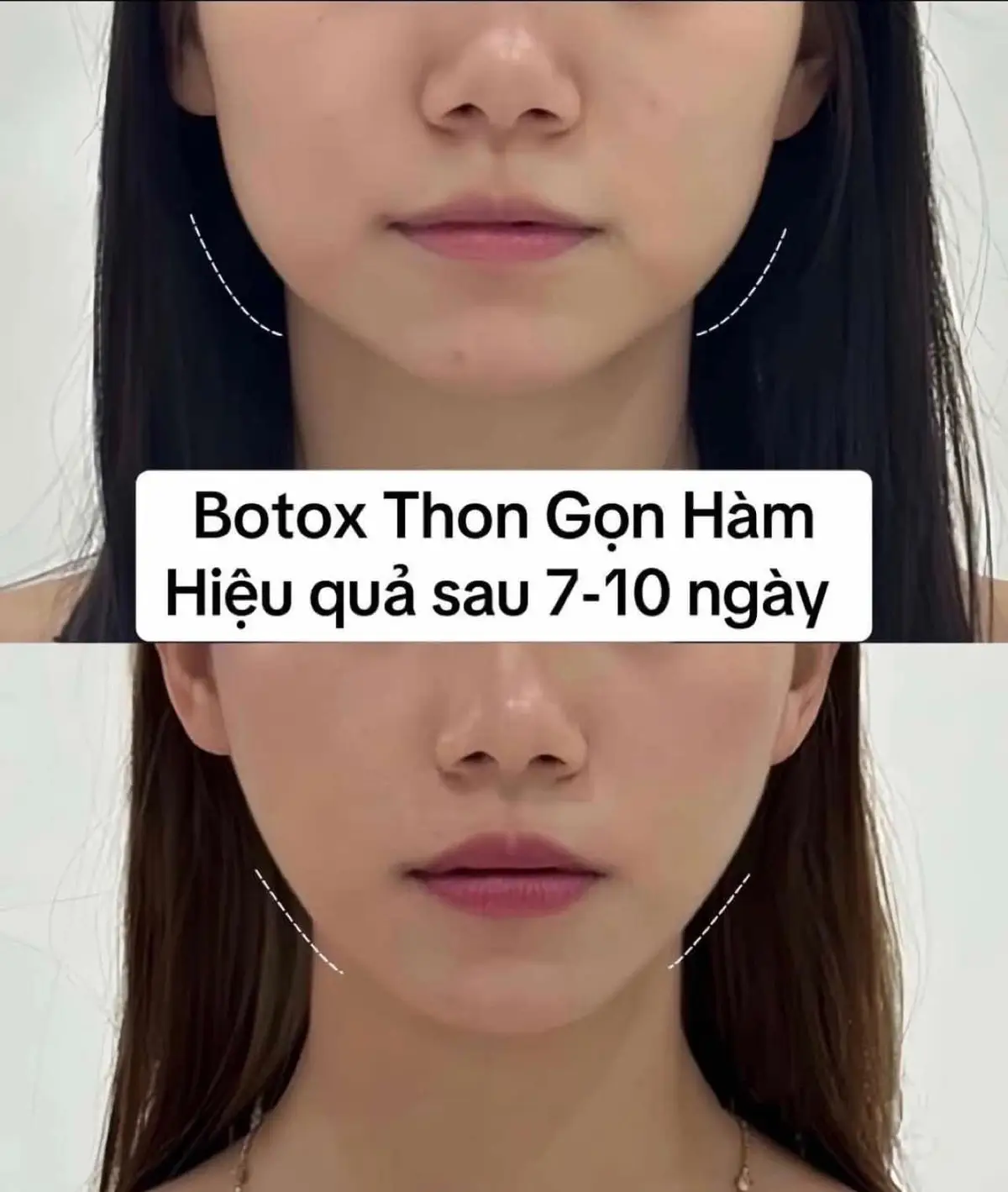 Botox gọn hàm đón Tết thôi mấy ní 1xxxk #botox #gonham 