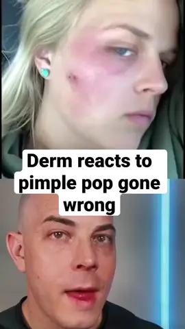 Pimple pop gone wrong! - #doctor #react #skincare #squeezeyuk #acne #pimple #pimplepop #blackhead #satisfying #foryoupage #foryou  #تنظيف_بشره  #whiteheads #رؤوس_سوداء #عنايه_بالبشره #دهون 