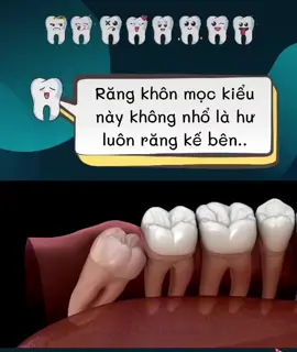 Bạn đã biết chiếc răng khôn làm bạn khó chịu cỡ nào #nhakhoa #nhakhoamientay #xuhuong #hot #can #cantho #nhakhoauytin #nhakhoakhongdau 