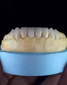 #prothesistedentaire #laboratoiredentaire #dent #zirconia #ceramiquedentaire #facettesdentaires #blanchimentdentaire #snaponsmile #cabinetdentaire #collaborationdentaire #millionaire #rich #messi #ronaldo #rose_dental_labo #foryou #pourtoi #tik_tok #الجالية_المغربية_في_كل_مكان🇲🇦🇲🇦 #الاسرة_العلوية #الحب❤️ #client 