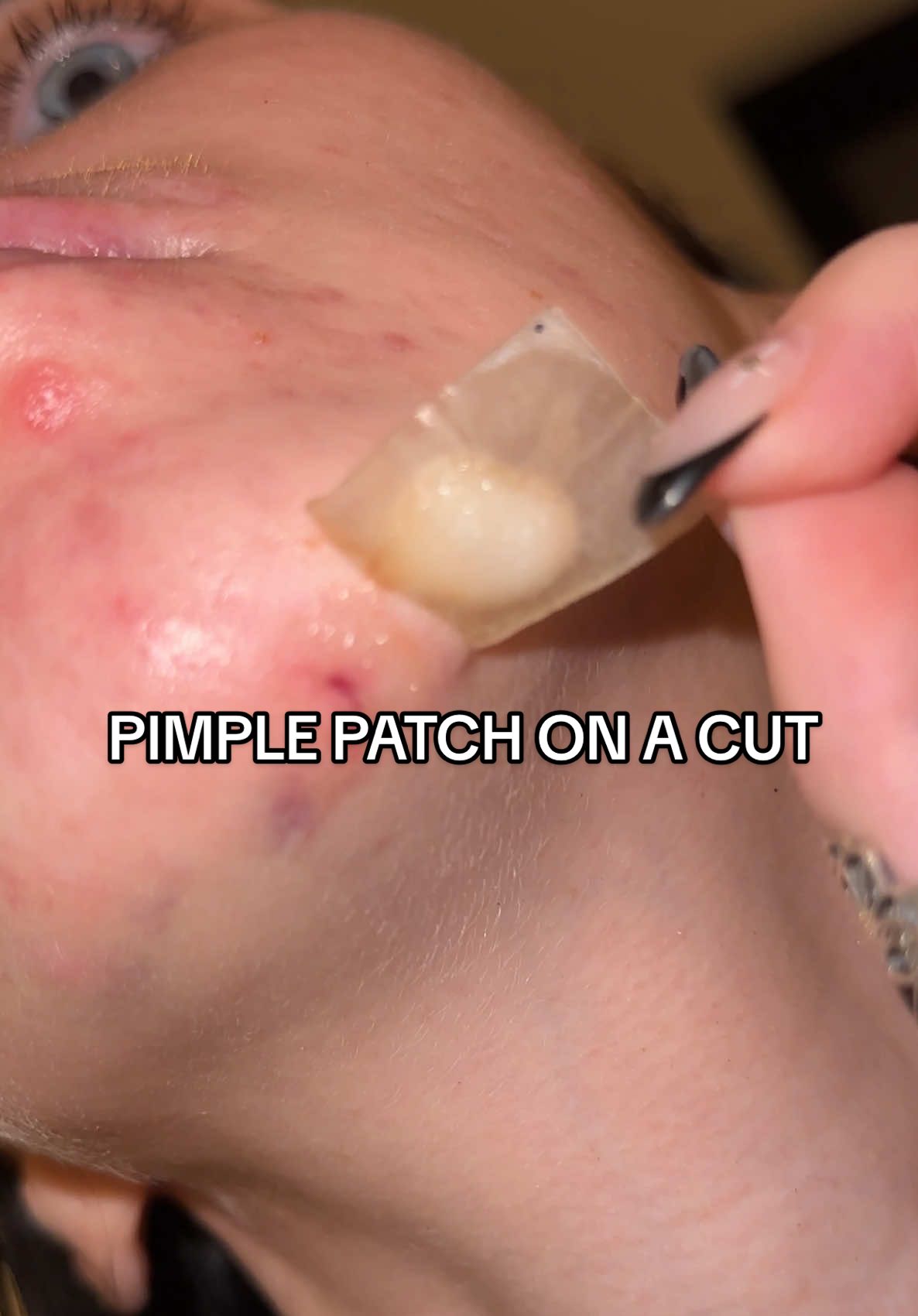 crashed a motorbike and cut open my chin in nicaragua so i put a pimple patch on the cut and it worked so well 😂 kept it clean and healed it quickly! #herocosmetics #pimplepatch #pimplepatchpeel 