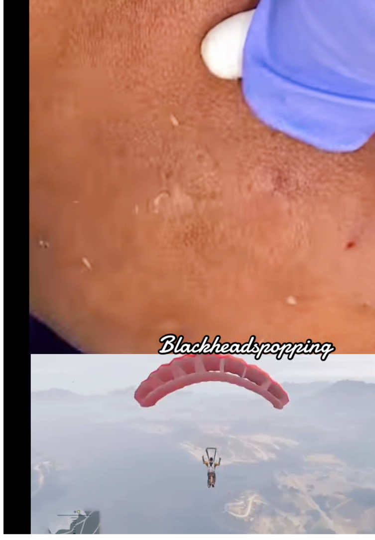 Skincare😍#tiktoklongs #extractions #pointnoirs #pourtoi #acné #gta5 #explore #acneskincare #challenge #fyp #foryou #satisfyingvideos #blackhead 