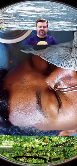 #foryou #removepimples #foreingobject #handacne #asmr #satisfyingvideo 