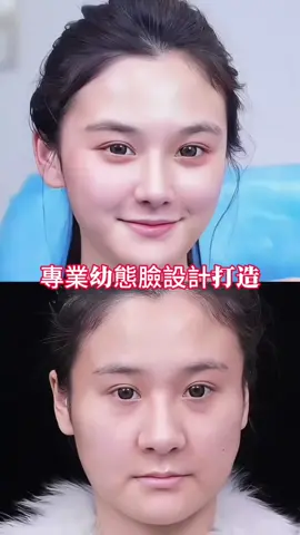 變美變年輕#幼態臉 #幼態 #醫美幼態 #輪廓固定 #幼态脸 
