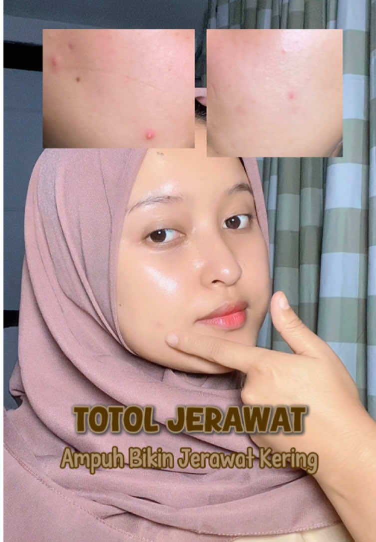 ampuh untuk kulit berjerawat!!🥰 #GRWM🌱 #skincareroutine #fyp 