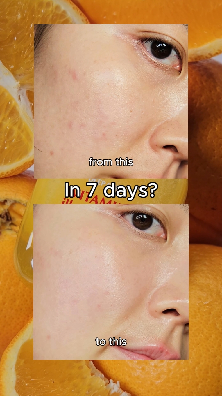 This vitamin serum from @Eqqualberry totally blew my mind🙊👏🏼👏🏼 Definitely the best serum for improving dark spots💛 #EQQUALBERRY #vitaminserum #eqqualberrybrighteningserun #juicyserum #kbeauty #koreanskincare #darkspots #acnescars #brightening #hyperpigmentation #vitaminc #skincaretiktok #glassskin #skincaretips #skincareroutine #kbeautyfinds #skintok #foryoupage #fyp