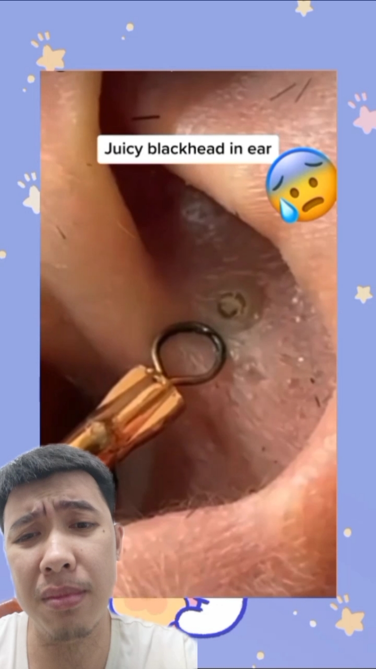 pimple acne skincare blackhead cyst popping satisfying video cleaning #pimple #acne #skincare #blackhead #cyst #popping #satisfying #satisfyingvideo #cleaning #CleanTok #satisfyingcleaning #fyp 