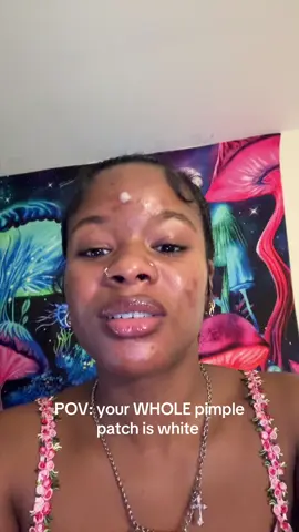 This is why i patch after extractions😂 #pimplepatch #acnejourney #acne #skintok 
