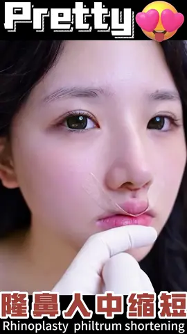 #rhinoplasty #nose #鼻综合 #鼻修复 #隆鼻 #鼻整形 #美女 #beauty #人中 #人中缩短 #philtrum 